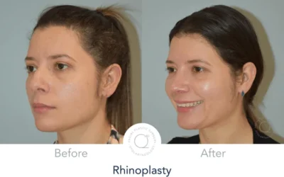 Descubriendo los peligros ocultos de una rinoplastia en clínicas low cost