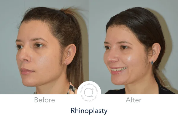 Rinoplastia en una clinica low cost