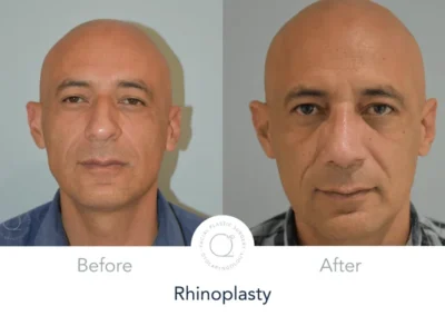 rinoplastia cerrada antes y despues