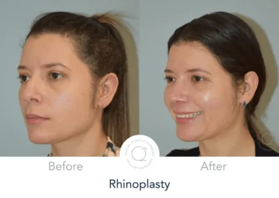 rinoplastia cerrada ejemplo antes y despues