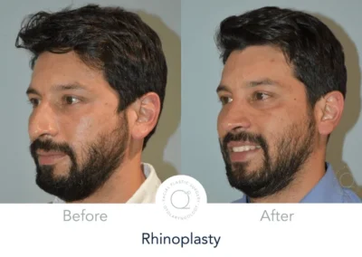 rinoplastia cerrada photo