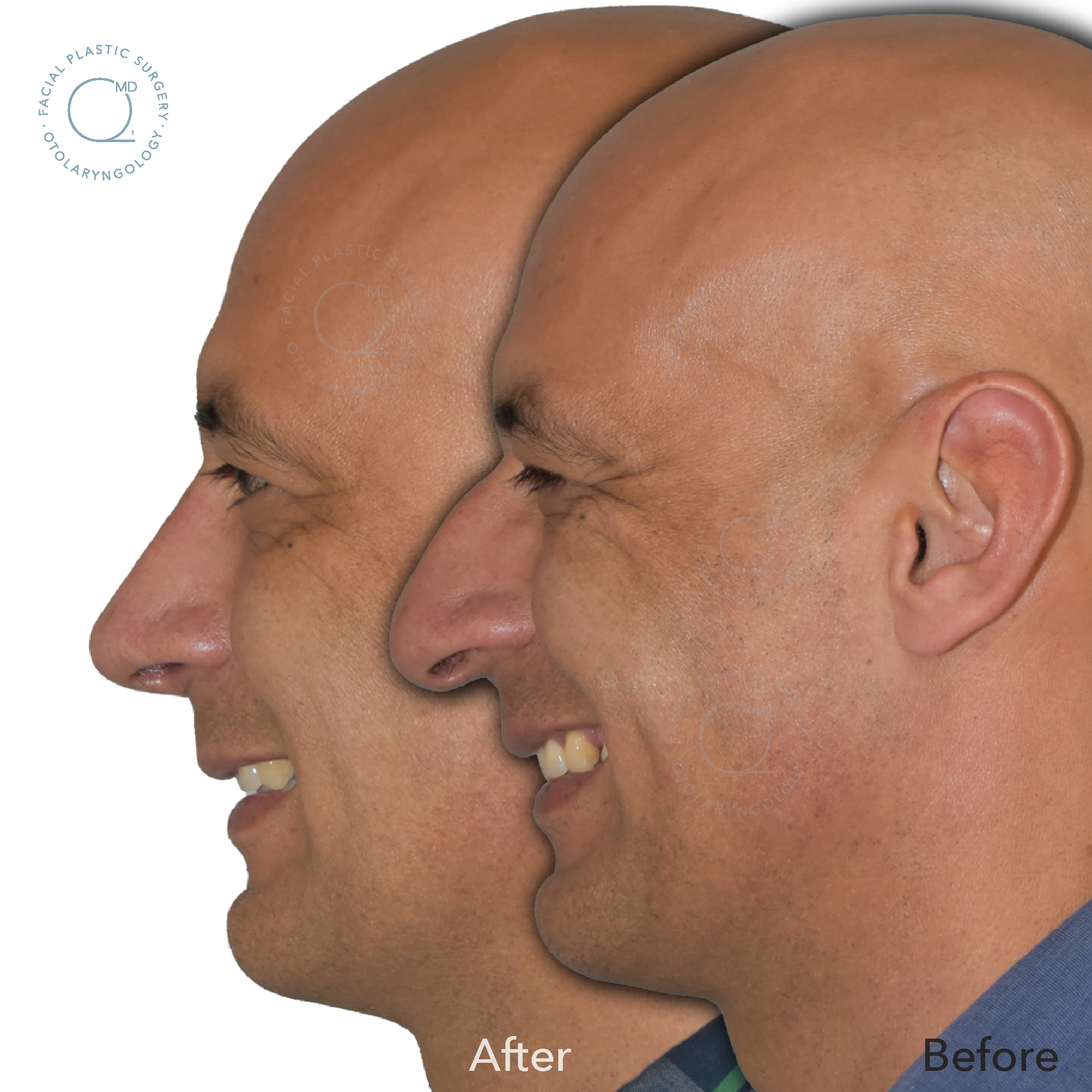 Rinoplastia hombre madrid antes y despues