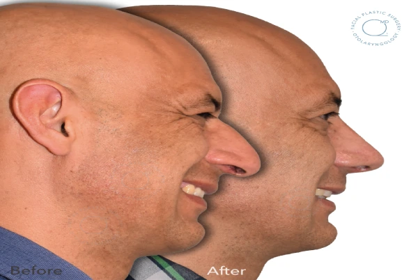 Rinoplastia hombre madrid antes y despues