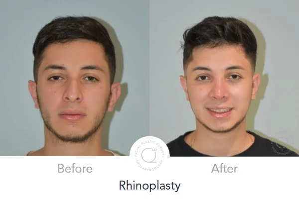 rinoplastia de un hombre despues su rinoplastia en Madrid