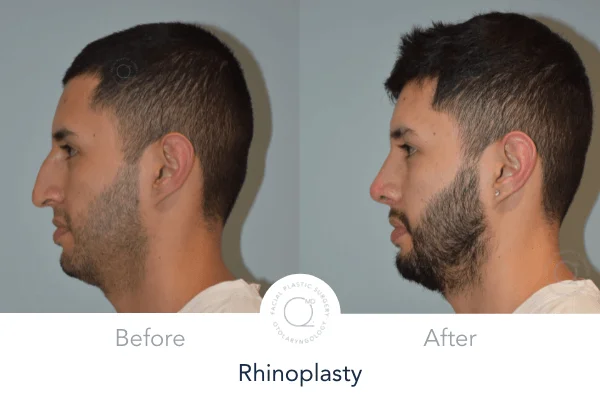 Rinoplastia Madrid foto hombre despues