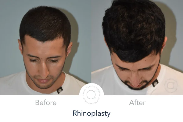 Rinoplastia Madrid foto abajo hombre