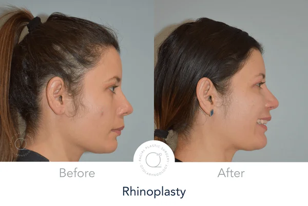 Rinoplastia Madrid paciente foto Alicia