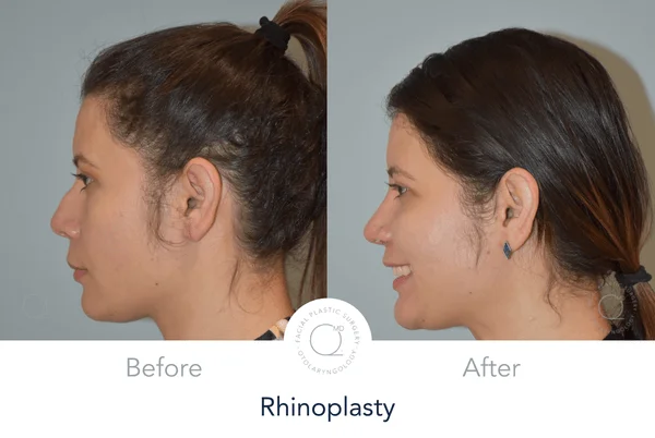 Rinoplastia Madrid perfil Alicia