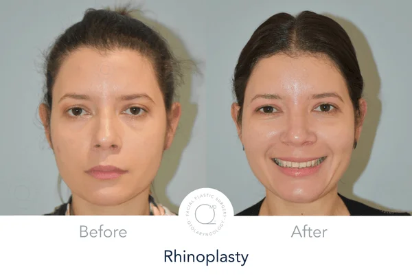 Rinoplastia Madrid perfil mujer Alicia