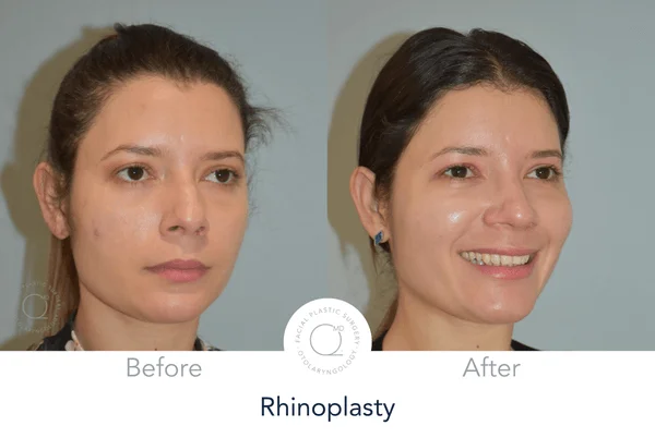 Rinoplastia Madrid perfil Alicia derecha