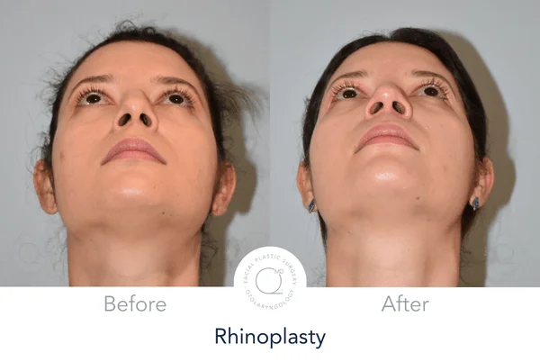 Rinoplastia Madrid perfil izquierda Alicia