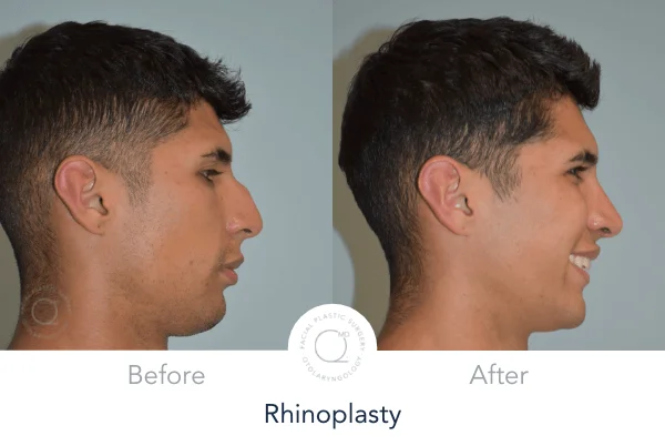 Rinoplastia Madrid foto hombre antes izquierda