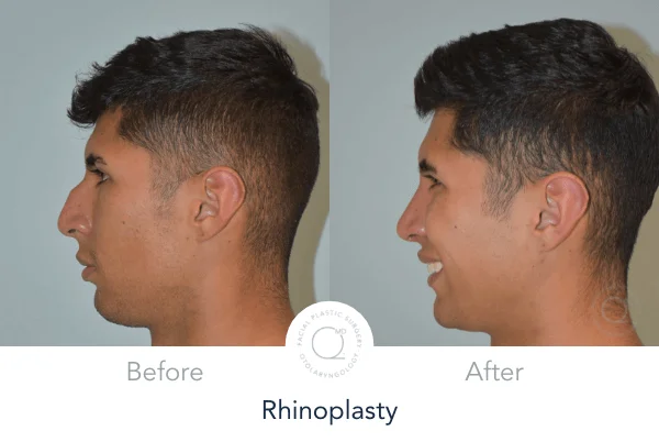 Rinoplastia Madrid foto hombres izquierda perfil