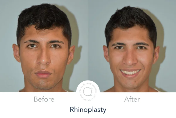 Rinoplastia Madrid perfil face 