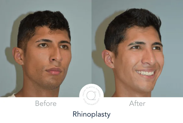 Rinoplastia Madrid foto perfil face