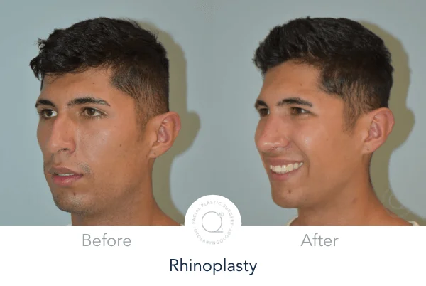 Rinoplastia Madrid foto perfil derecha