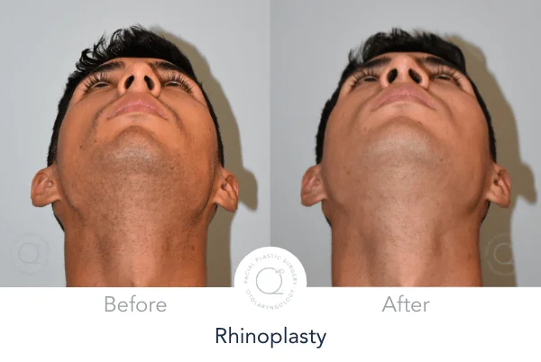 Rinoplastia Madrdi perfil hombre derecha foto