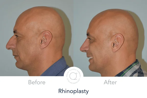 rinoplastia madrid Clinicas Duque Madrid Salamanca