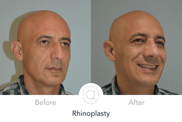 Rinoplastia Madrid Dr Duque Silva Madrid