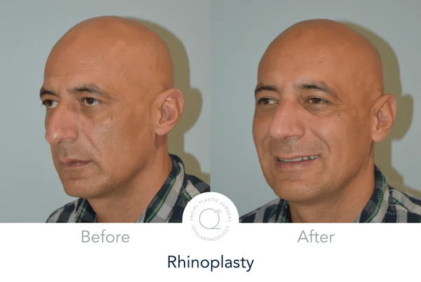 Rinoplastia clinicas duque Madrid