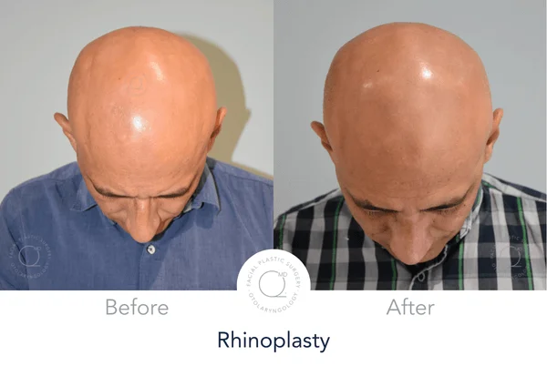 Rinoplastia Hombre Clinicas Duque Madrid