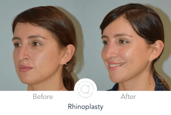 rinoplastia clinicas duque Madrid 28