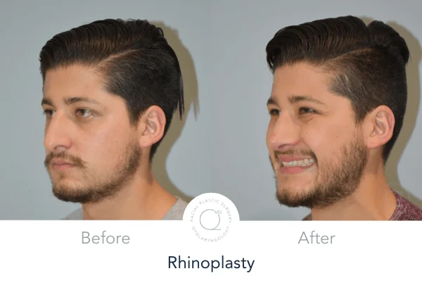 rinoplastia madrid clinicas rinoplastia