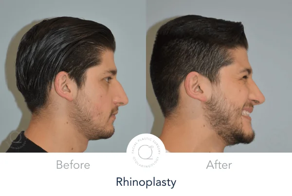 rinoplastia madrid clinicas duque Salamanca