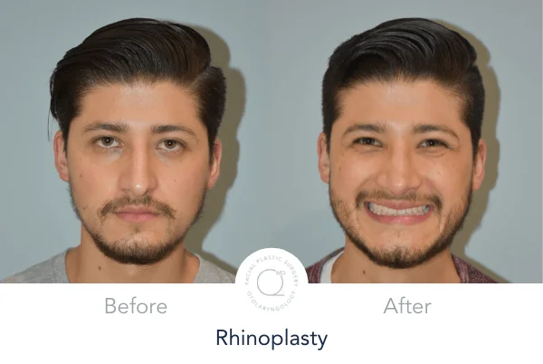 rinoplastia Madrid Doctor Duque Silva