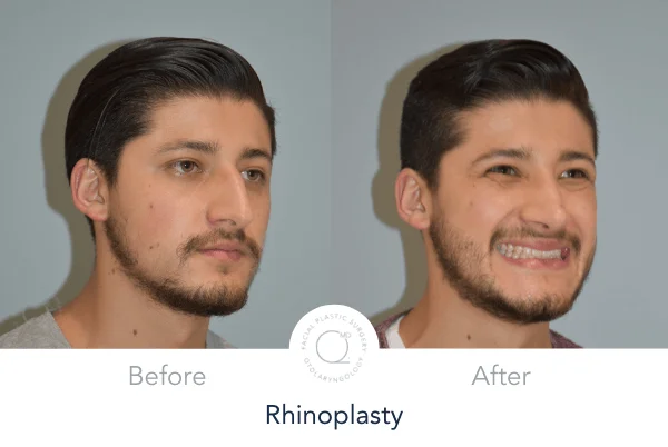 Rinoplastia Madrid Duque Salamanca Madrid