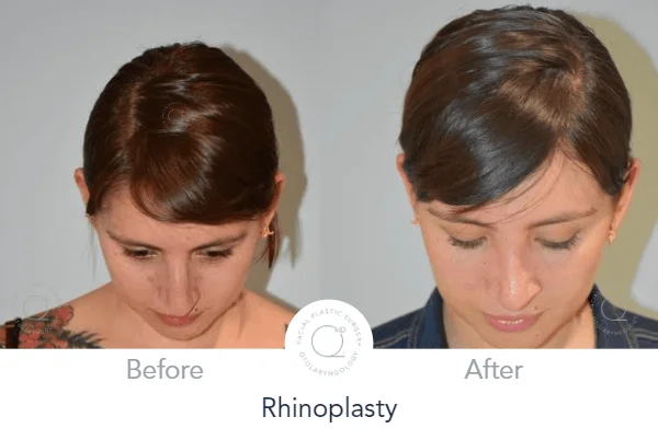 rinoplastia madrid duqueMD