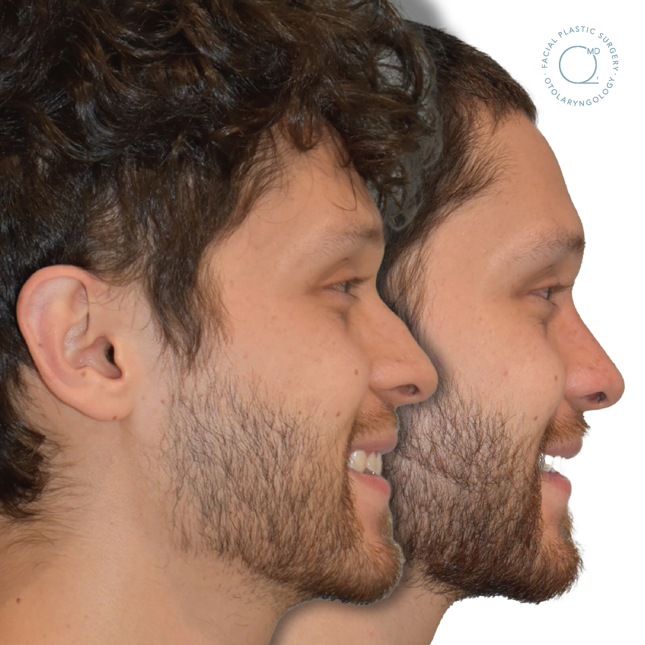 Rinoplastia Madrid foto hombre nariz