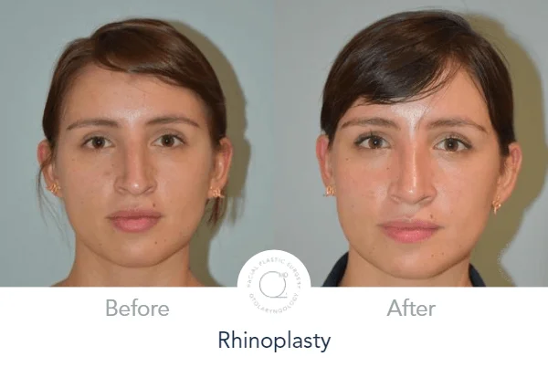 Rinoplastia Madrid foto paciente clinicas Duque