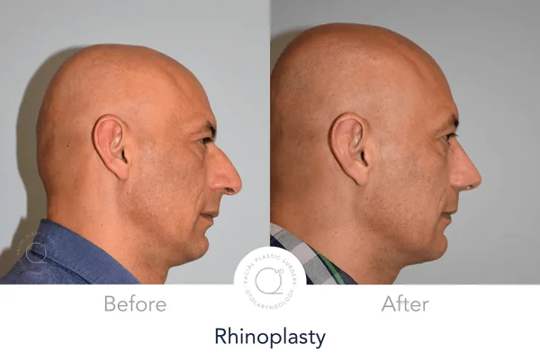 Rinoplastia Madrid Hombre Clinicas Duque 