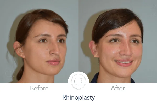 rinoplastia madrid mujer clinicas duque 