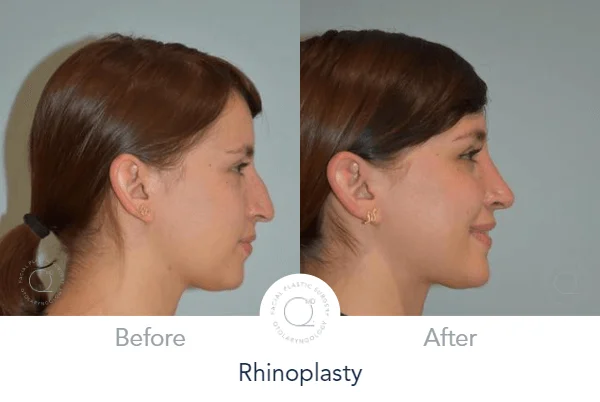 rinoplastia Madrid paciente Clinicas Duque Madrid