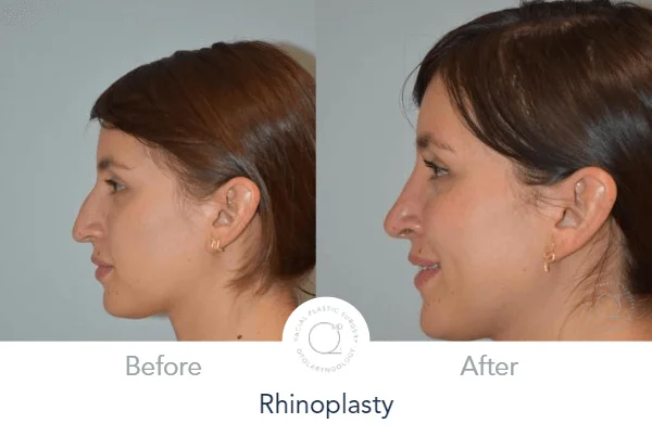 Rinoplastia Madrid paciente Clinicas Duque Madrid